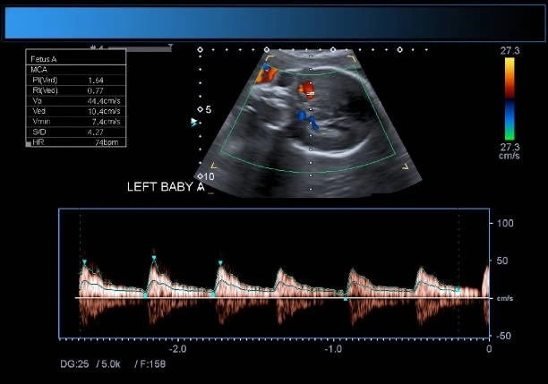 Fetal echo Madurai fetal cardiology baby heart monitor ultrasound prenatal heart check at Meera 4D Scans fetal scan centre Madurai advanced fetal imaging