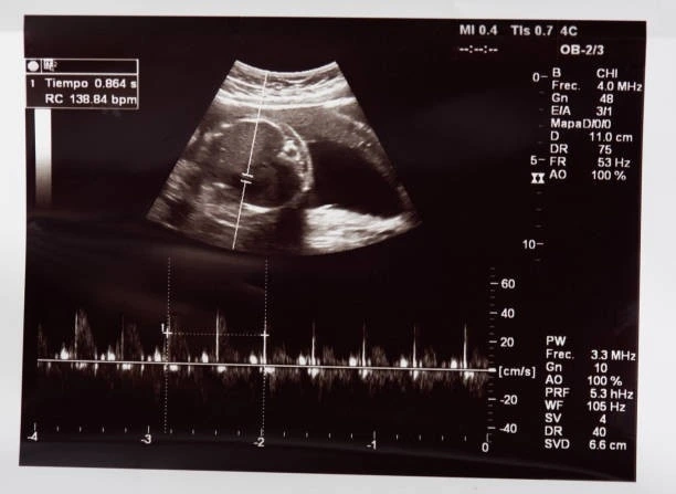 Fetal echo Madurai baby heart monitor ultrasound congenital heart screening advanced fetal imaging at Meera 4D Scans fetal scan centre Madurai