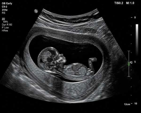 Early pregnancy scan 7 week ultrasound heartbeat scan at Meera 4D Scans scan centre in Madurai