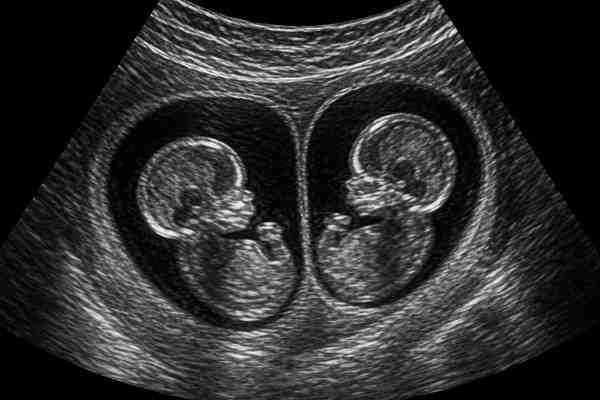 Multiple pregnancy scans chorionicity scan twin ultrasound milestones at Meera 4D Scans fetal scan centre Madurai specialist fetal care