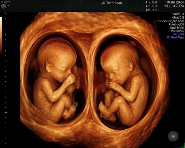 Twin pregnancy scan schedule India specialist fetal care twin pregnancy doctors Madurai at Meera 4D Scans fetal scan centre Madurai
