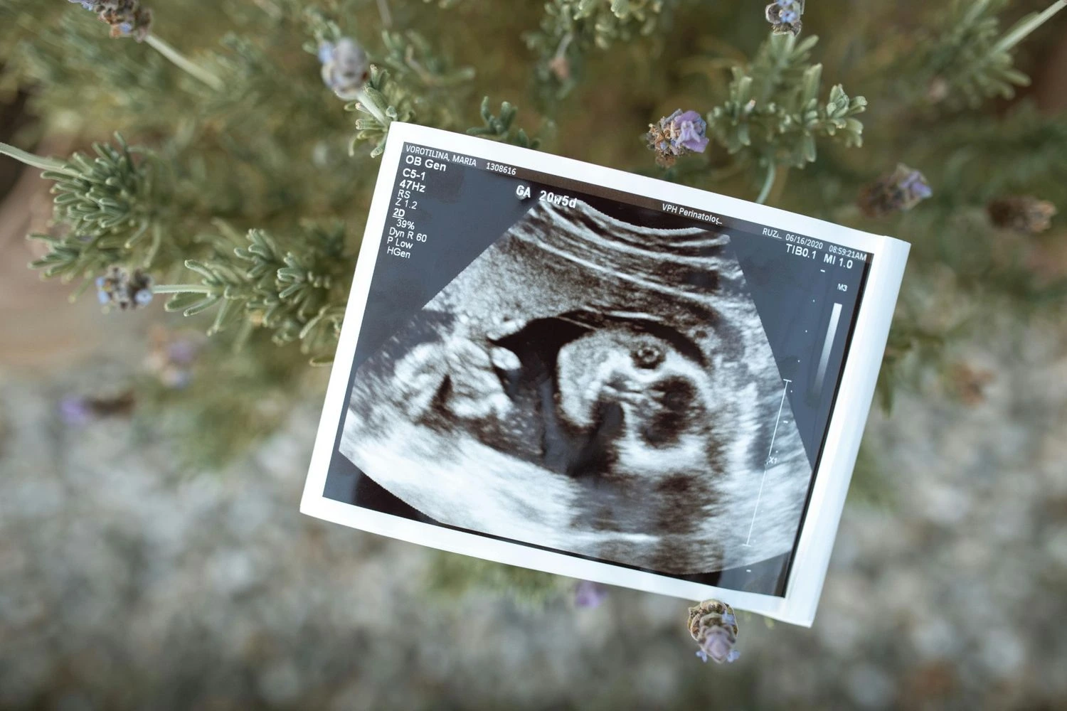 Fetal Echo