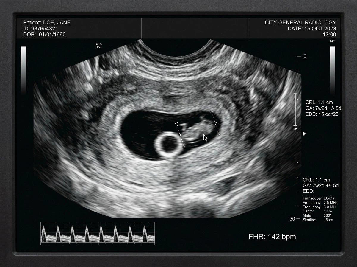 Antenatal Scan